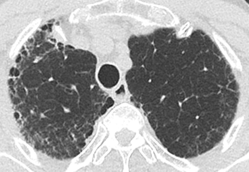 Diagnostic radiologique de la fibrose pulmonaire idiopathique | OPA ...