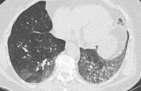 Pour changer de la Covid : un métapneumovirus ! 