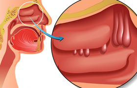 Polypose nasosinusienne et asthme