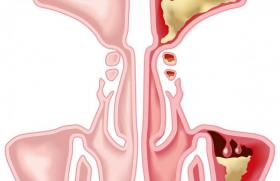 Chirurgie sinusienne :  trucs et astuces 