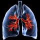 Mise à disposition du dupilumab‚ première biothérapie ciblant l’inflammation de type 2 dans l’asthme sévère