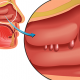 Polypose nasosinusienne et asthme