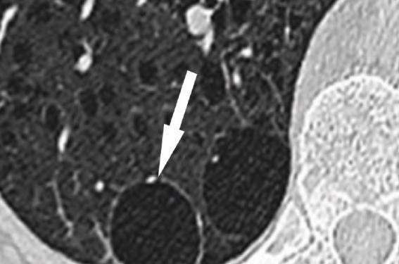 Découverte de kystes pulmonaires au scanner : orientations ...