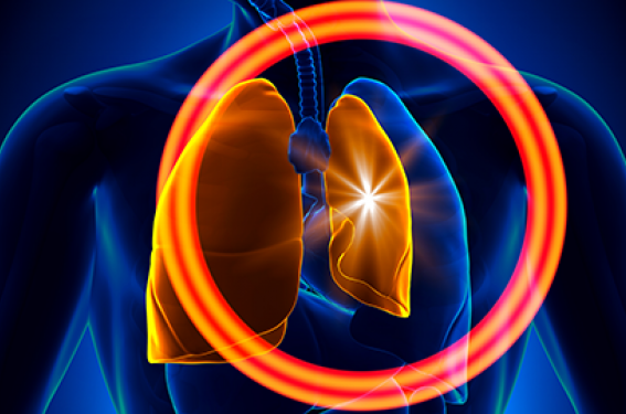 Pneumothorax spontanés primaires : de nouvelles recommandations