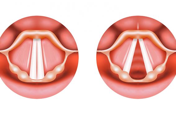 Ne pas confondre dysfonction des cordes vocales et dysfonction respiratoire