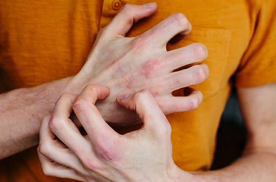 Eczéma allergique : allergènes connus, allergènes émergents