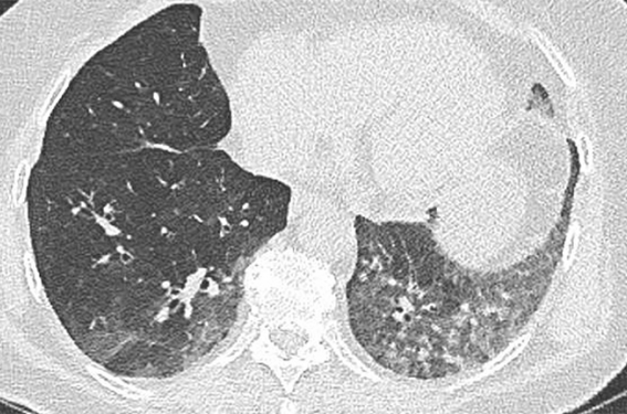 Pour changer de la Covid : un métapneumovirus ! 