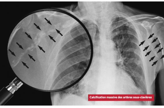 Quand le calcium est sur les vaisseaux... attention aux os !