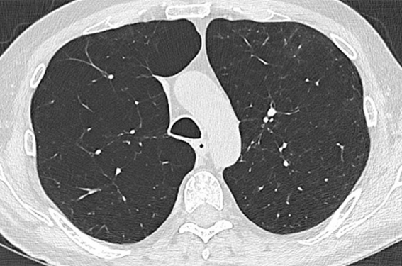 Emphysème pulmonaire : prévalence et impact clinique Quelles données en 2023 ?