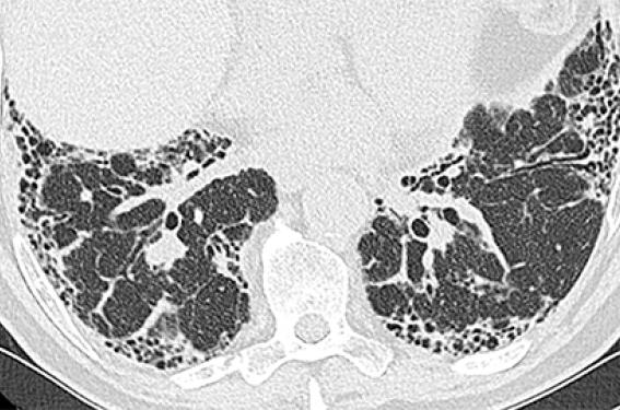 Traitement de la fibrose pulmonaire idiopathique