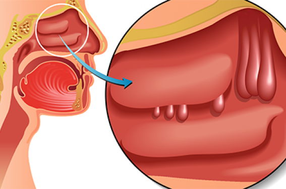 Polypose nasosinusienne et asthme