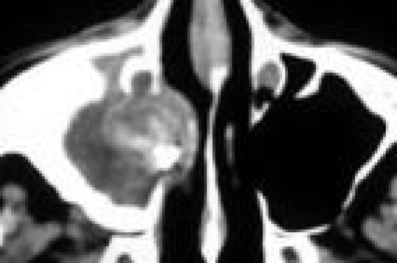 Les mycoses nasosinusiennes | OPA Pratique